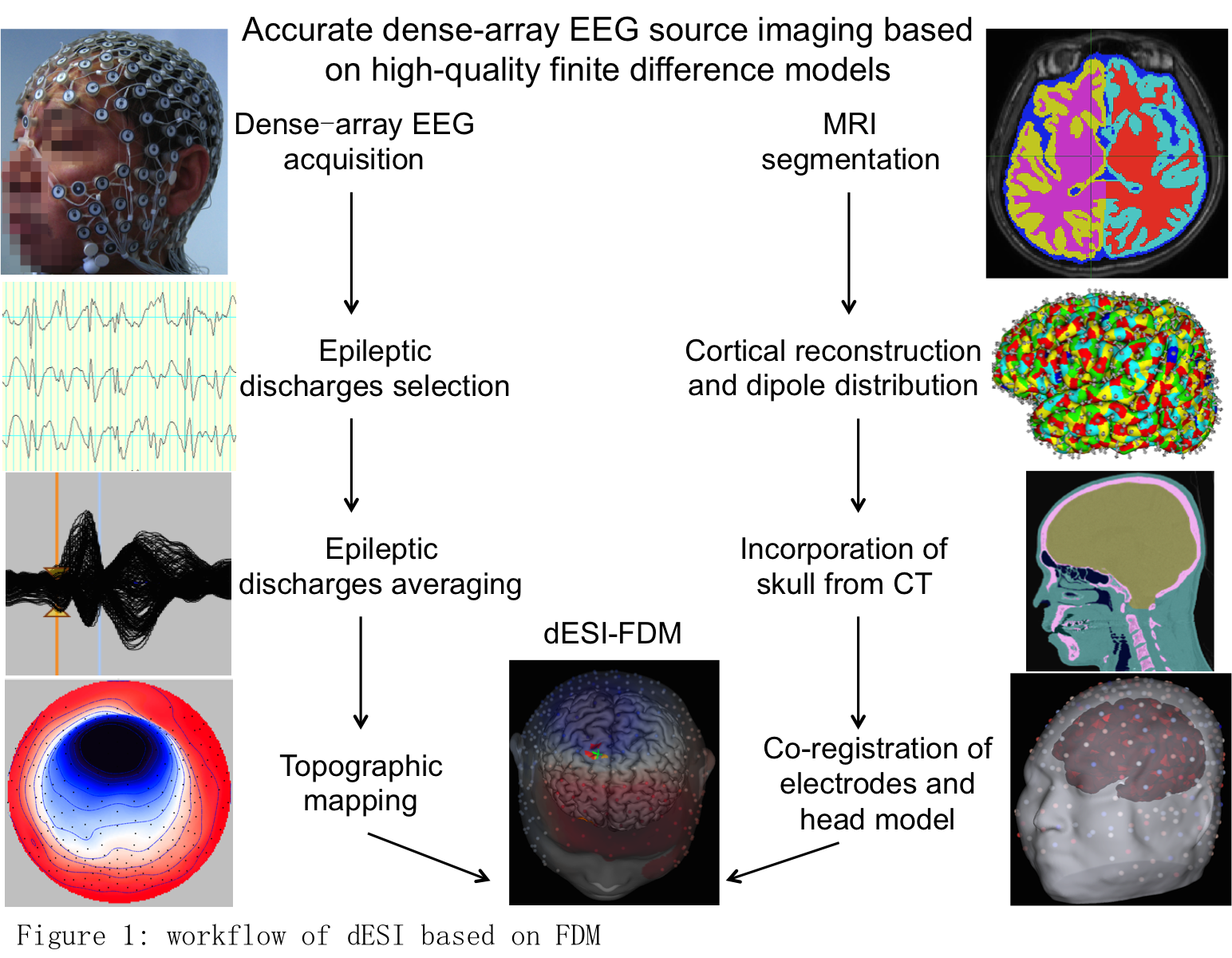 Accurate-dense-array-electroencephalographic-source-imaging-based-on ...