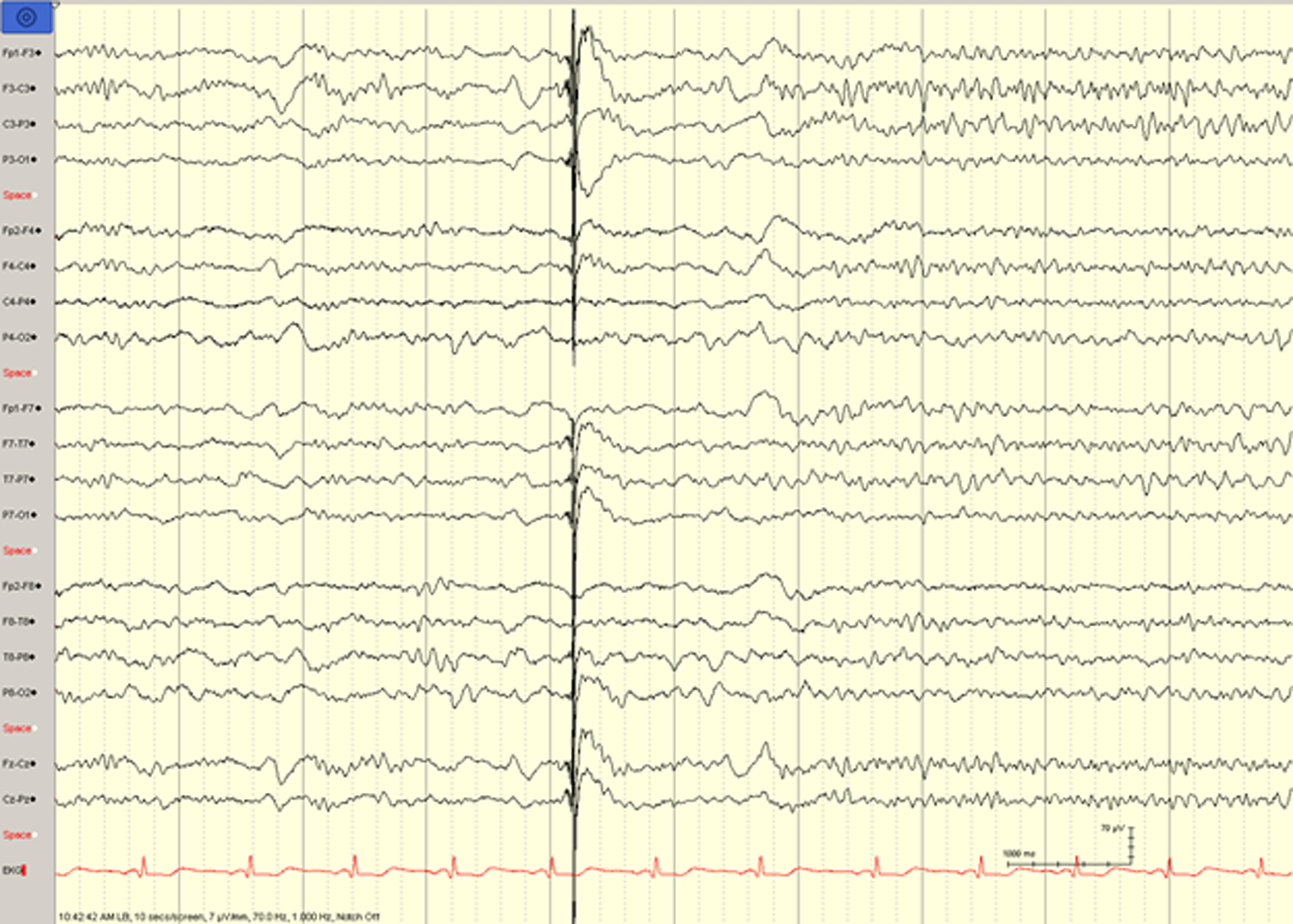 Neurostimulateurs (RNS / DBS)