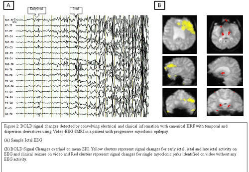 IMPLEMENTATION-OF-VIDEO-EEG-FMRI-TO-INVESTIGATE-EPILEPTIC-ACTIVITY