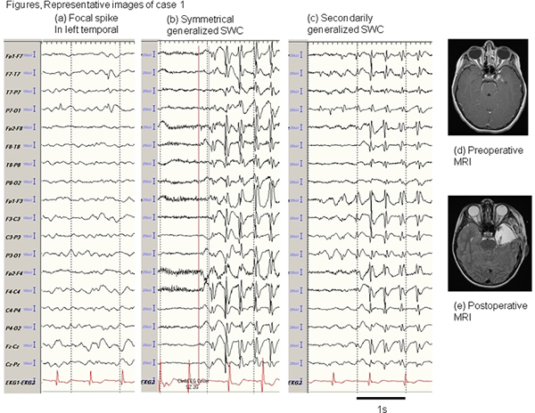 Generalized-3-Hz-spike-and-wave-complexes-emanating-from-focal ...