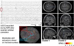 Simultaneous-intracranial-EEG-and-fMRI-of-interictal-epileptic ...