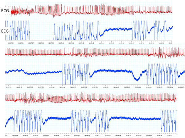 Ictal-death-in-Dravet-syndrome-model-mice