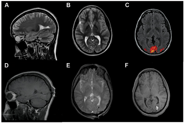 Awake-Stereotactic-Laser-Ablation-of-Focal-Cortical-Dysplasia-with ...