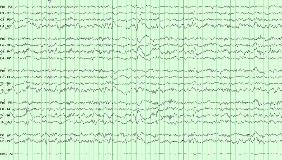 SIBLINGS-WITH-JUVENILE-HUNTINGTON'S-DISEASE-HAVING-TWO-DIFFERENT ...