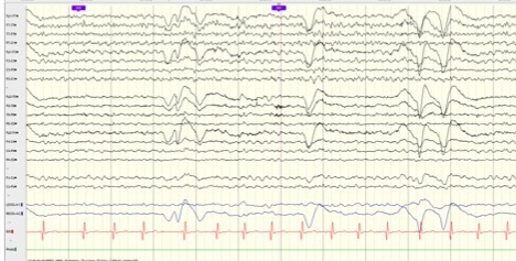 Unusual-EEG-pattern-in-case-of-Prader-Willi-Syndrome