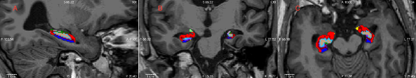 Contralateral-Hippocampus-in-Temporal-Lobe-Epilepsy