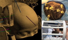 Early-Outcomes-of-Stereoelectroencephalography-Followed-by-MR-Guided ...