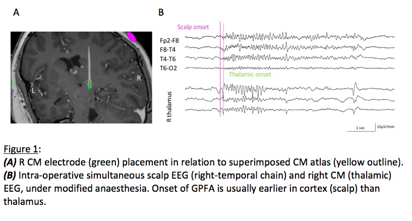 Cortex-Leads-Thalamus-in-Tonic-Seizures-of-Lennox-Gastaut-Syndrome