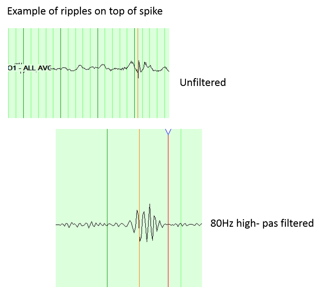 HighFrequencyOscillationsonInterictalEpileptiformDischargesin