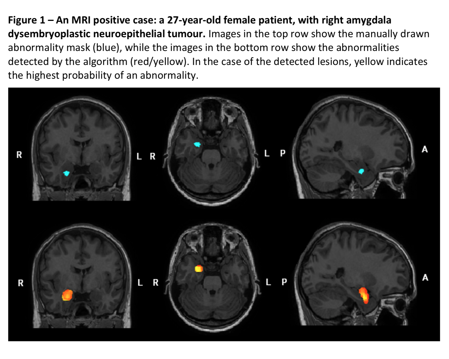 The+world%26%238217%3Bs+first+epilepsy+machine+placed+in+a+boy%26%238217%3Bs+skull+in+London+hospital+%26%238211%3B+Evening+Standard