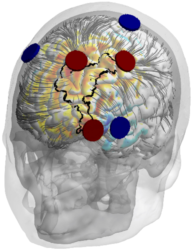 Targeted Non Invasive Neurostimulation Meaningfully Reduces Seizure Frequency In Refractory 8812