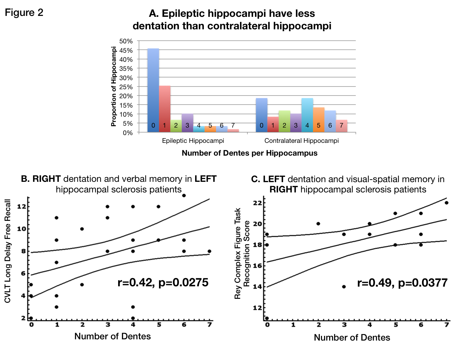 loss-of-hippocampal-dentation-is-a-hallmark-of-hippocampal-sclerosis