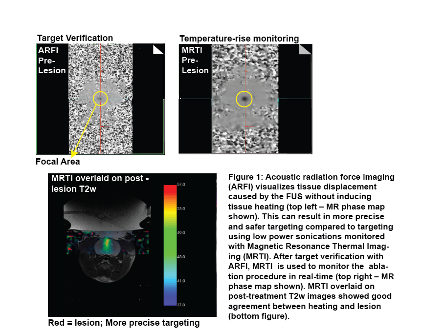 Development-of-an-MR-Guided-Focused-Ultrasound-(MRgFUS)-Approach-for ...