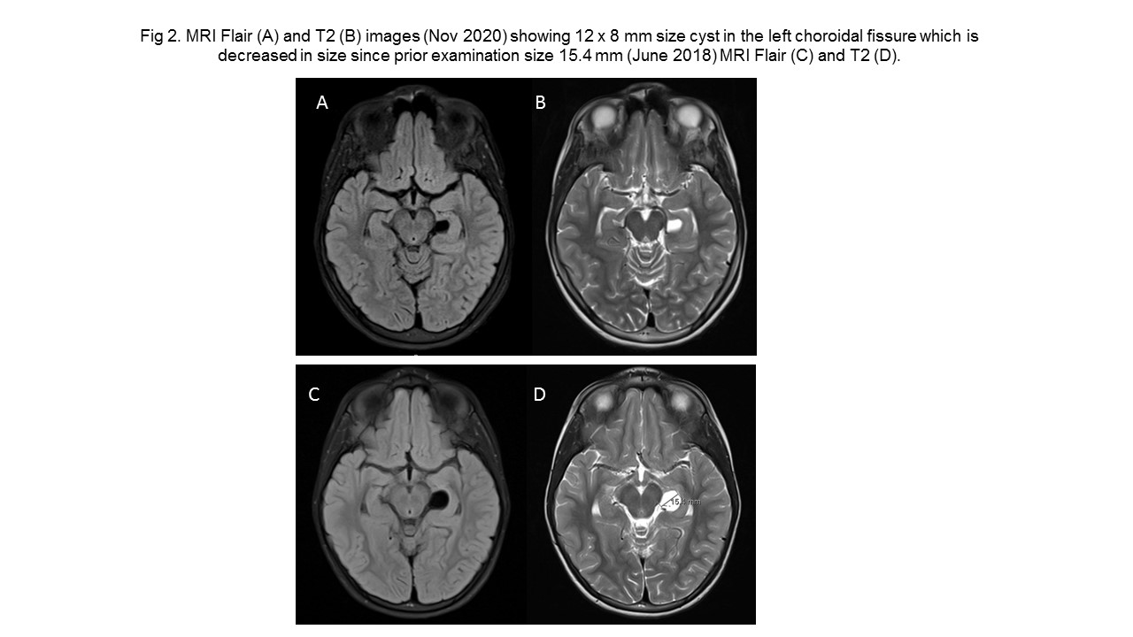 Novel Gene Abnormality In Epilepsy With Myoclonic Astatic Seizures Doose Syndrome