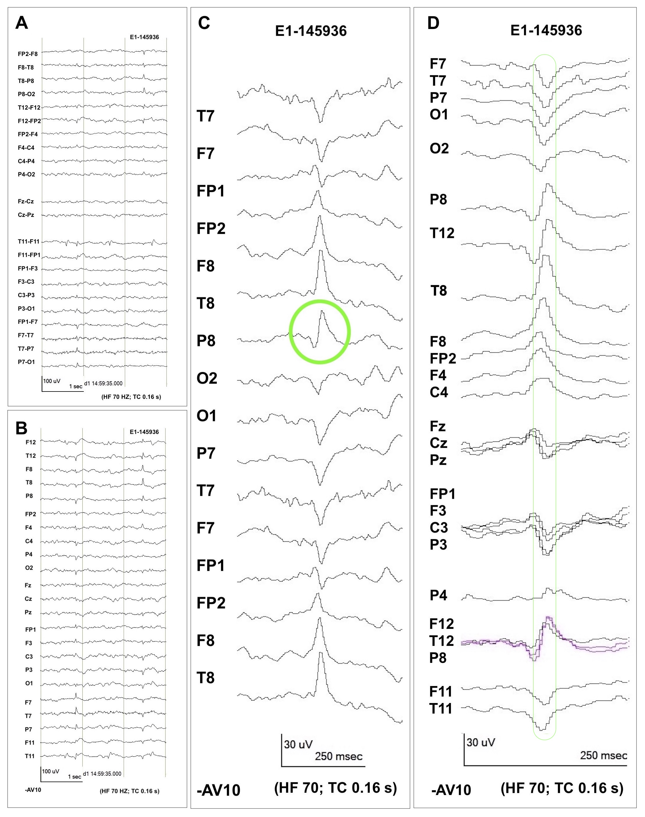 polygraphic localization of deep eeg generator