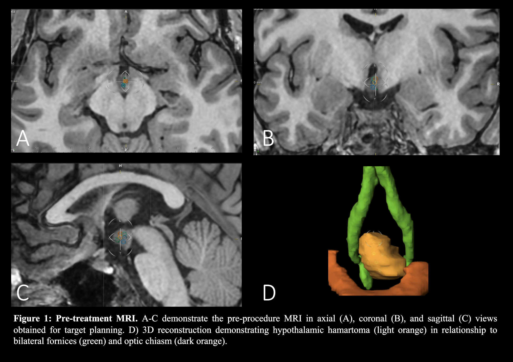 high-intensity focused ultrasound for treatment of hypothalamic ...