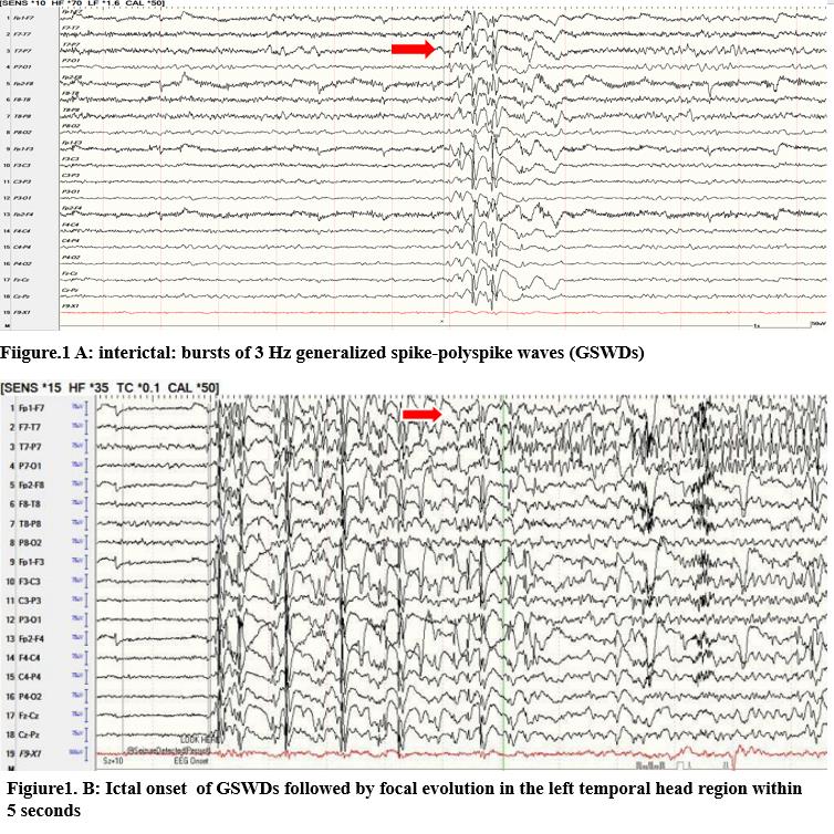 stereotactic electroencephalography seeg proved generalized and